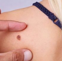 Inicia la campaña de prevención del cáncer de piel