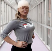 Salte&ntilde;a se quem&oacute; casi el 90% de su cuerpo cuando era beb&eacute; y hoy es un ejemplo de superaci&oacute;n