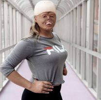 Salteña se quemó casi el 90% de su cuerpo cuando era bebé y hoy es un ejemplo de superación