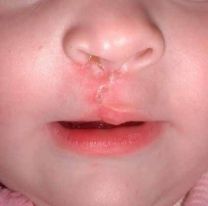 Conoc&eacute; d&oacute;nde operan de labio leporino a muchos salte&ntilde;os