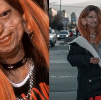 Falleció Juli, la salteña con envejecimiento prematuro