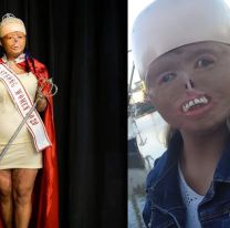 A los 7 meses un incendio le quem&oacute; el 88% del cuerpo, hoy triunfa en cada meta que se propone