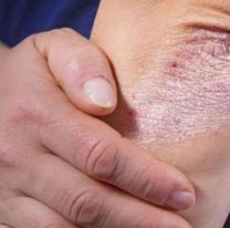 Mañana será la jornada de  detección de psoriasis en el hospital San Bernardo