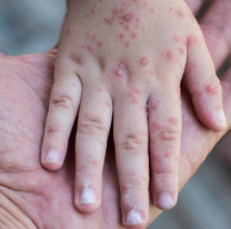 Advierten un posible brote de sarampi&oacute;n: la recomendaci&oacute;n para los salte&ntilde;os